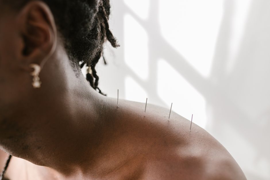 where are the acupuncture points